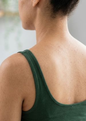 peels treatment