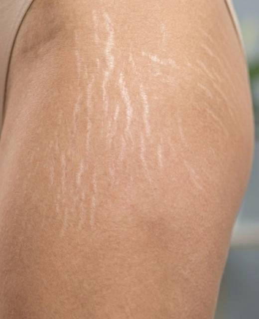 stretch marks treatment