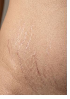 stretch marks procedure