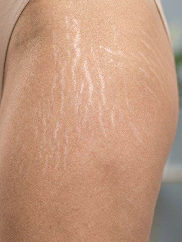 stretch marks treatment