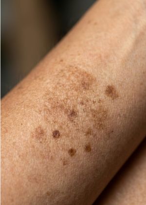 sun damage areas