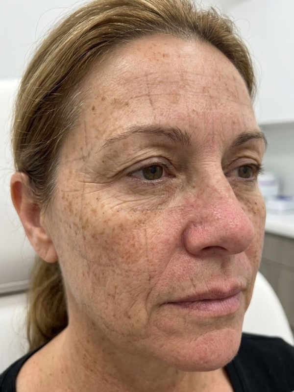 sun damage treatment