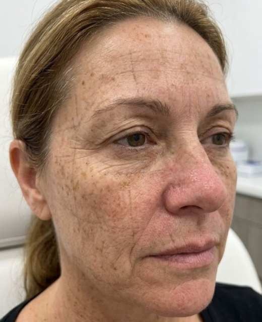 sun damage treatment