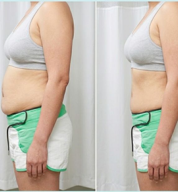 tummy tuck