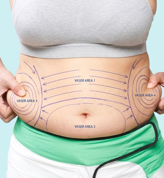 vaser liposuction