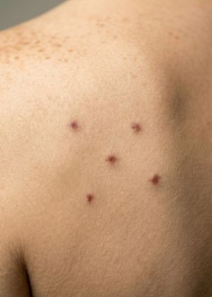 warts treatment areas
