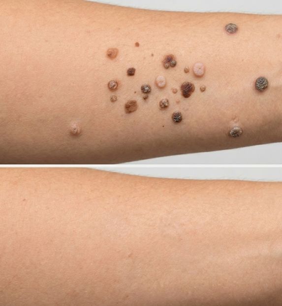 warts removal