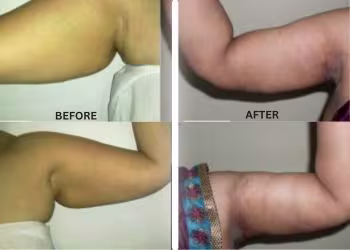 Arm Lift Surgery in Hyderabad