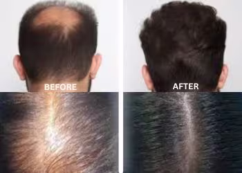 Hair Care Treatment in Hyderabad