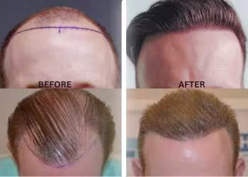 Innovative Hair Transplant Surgery in Hyderabad