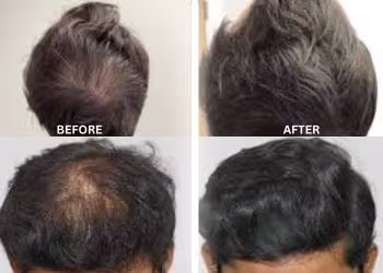 PRP Treatment in Hyderabad