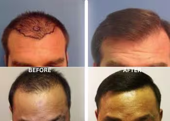 Strip Technique Hair Transplant Surgery in Hyderabad