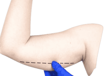 Arm Lift Surgery in Hyderabad
