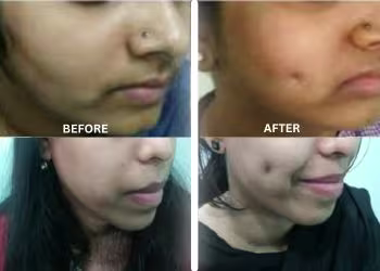 Dimple Creation Surgery in Hyderabad