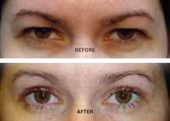 Eyelid Surgery in Hyderabad