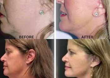 Face Lift Surgery in Hyderabad