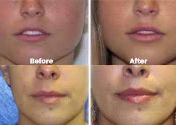 Lip Augmentation Surgery in Hyderabad