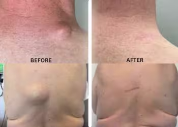 Lipoma Treatment in Hyderabad, India