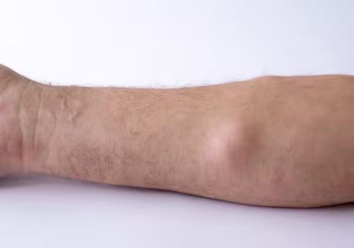 Lipoma Treatment in Hyderabad, India