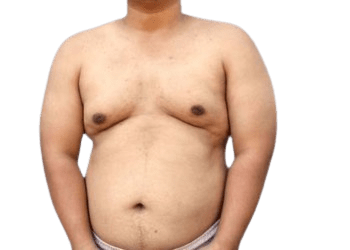 Gynecomastia Treatment in Hyderabad