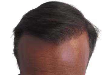 Strip Technique Hair Transplant Surgery in Hyderabad
