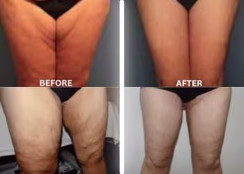 Thigh Shaping Treatment in Hyderabad