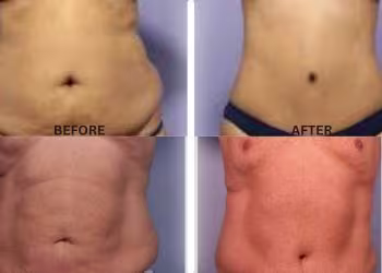 Tummy Tuck Treatment in Hyderabad