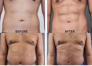 vaser Liposuction Surgery in Hyderabad