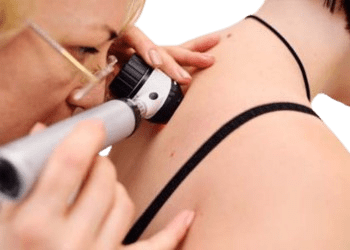 Moles Wart Removal Treatment in Hyderabad