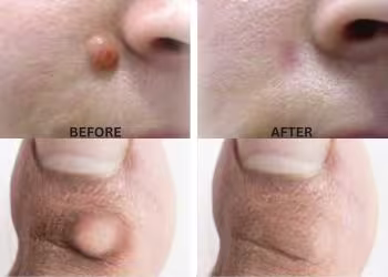 Moles Wart Removal Treatment in Hyderabad