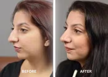 Face Surgery in Hyderabad