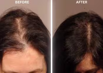Hair Restoration Treatment in Hyderabad