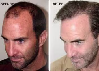 Hair Concern Treatments in Hyderabad