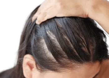 Hair Concern Treatments in Hyderabad