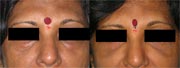 Brachioplasty Before and After