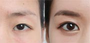 Eye Lid Surgery Before and After