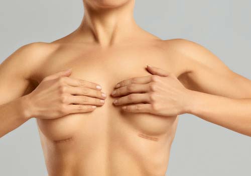 Breast Asymmetry Treatment in Hyderabad, India