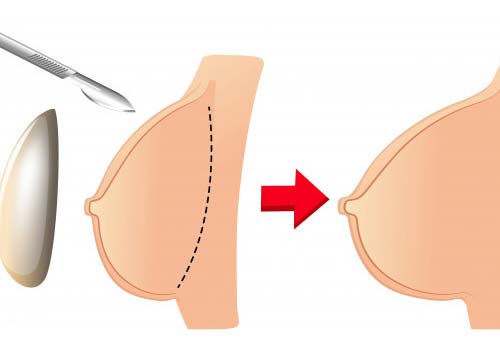 Breast Reconstruction Surgery