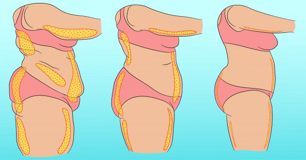 Post-Bariatric Surgery in Hyderabad