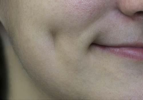 Dimple Creation Surgery in Hyderabad, India