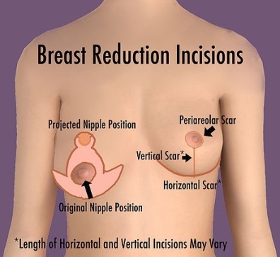 Image result for breast reduction images scars