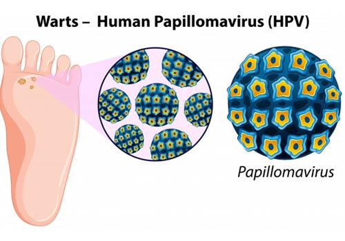 Warts Removal