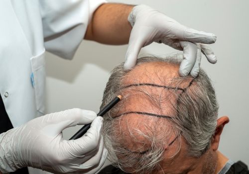 innovative hair transplant