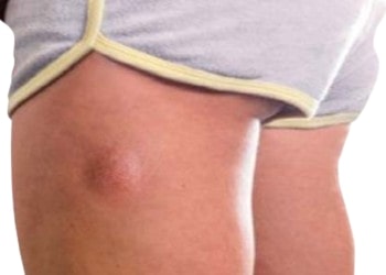 lipoma treatment