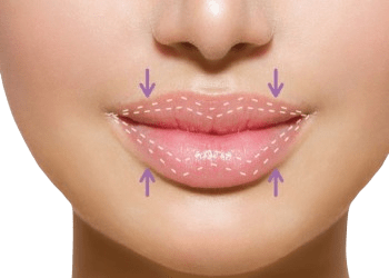 lipreduction