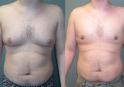 Gynecomastia Treatment