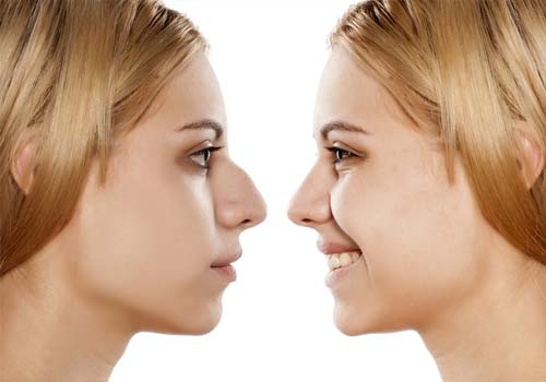 Rihnoplasty surgery